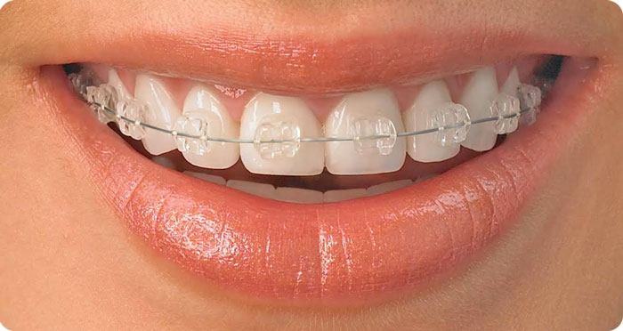 ارتودنسی فلزی بهتر است یا نامرئی؟