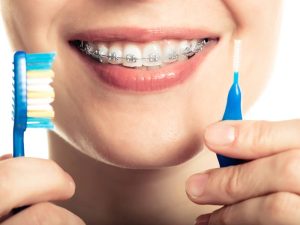 مسواک ارتودنسی بین دندانی چیست؟