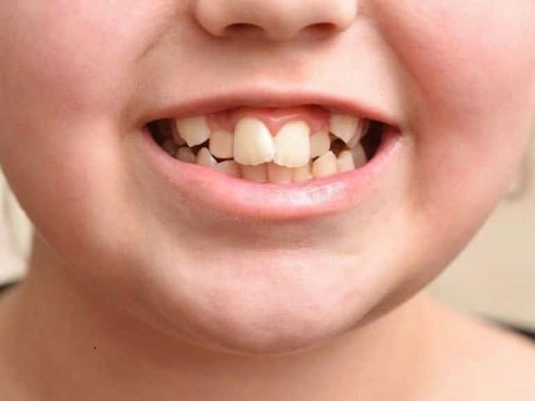 علت کج شدن دندان ها در کودکان